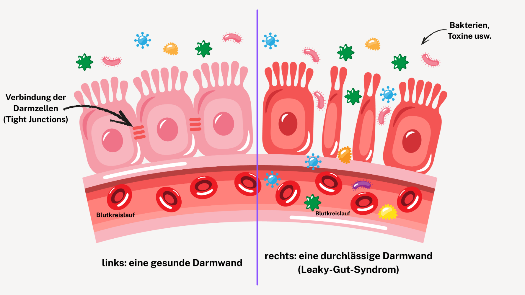 Leaky Gut Syndrom